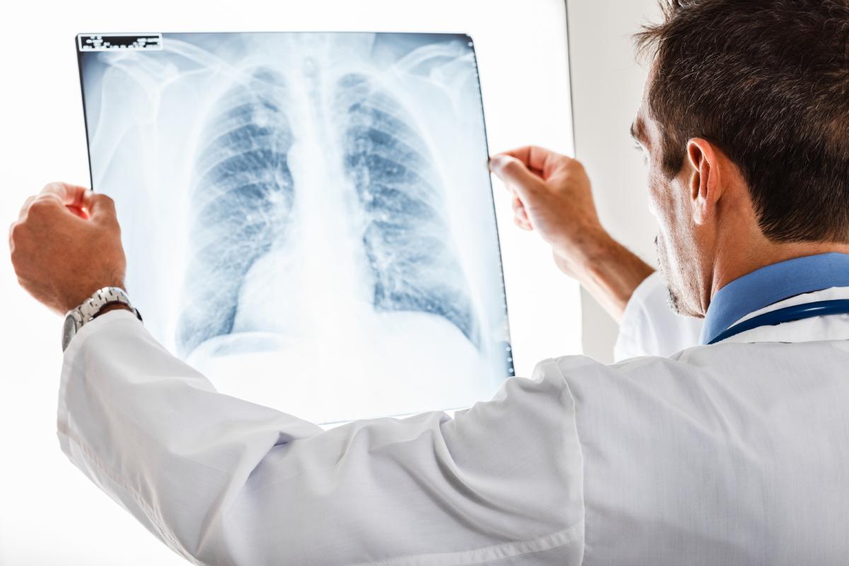 doctor looking at chest x-ray of lungs with lung scarring