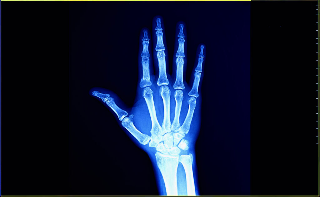 Arthritis can be detected using X-Ray