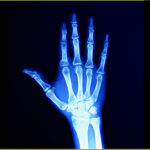 Can You Detect Arthritis from an X-Ray?