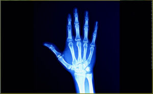 Arthritis can be detected using X-Ray