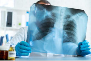 Studying risk factors for developing lung cancer